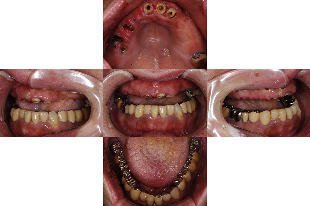 前歯が外れた（50代）インプラント・セラミック修復