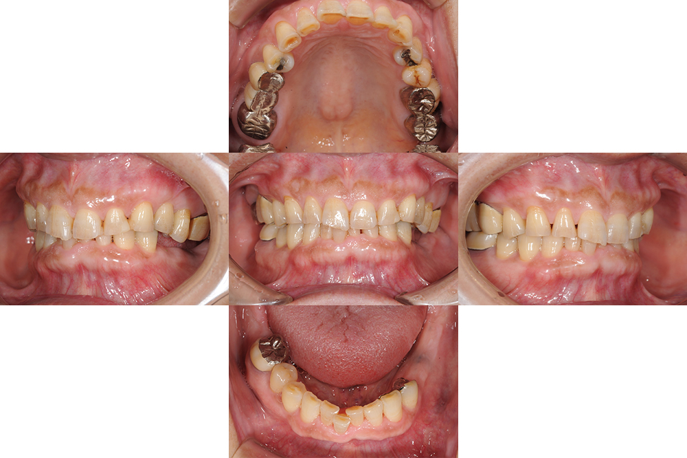 前歯が欠けた（70代）インプラント・セラミック修復