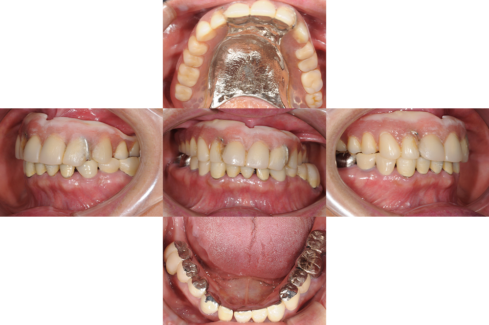 前歯がグラグラする（60代）インプラント・セラミック修復・金属床義歯