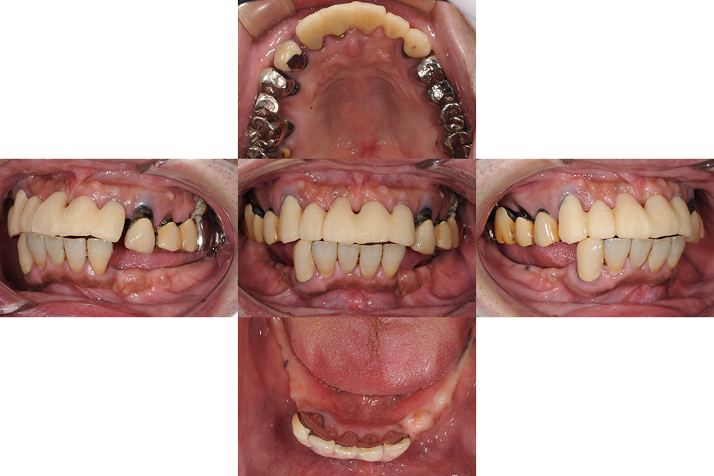 奥歯が外れた（50代）インプラント・セラミック修復・金属床義歯