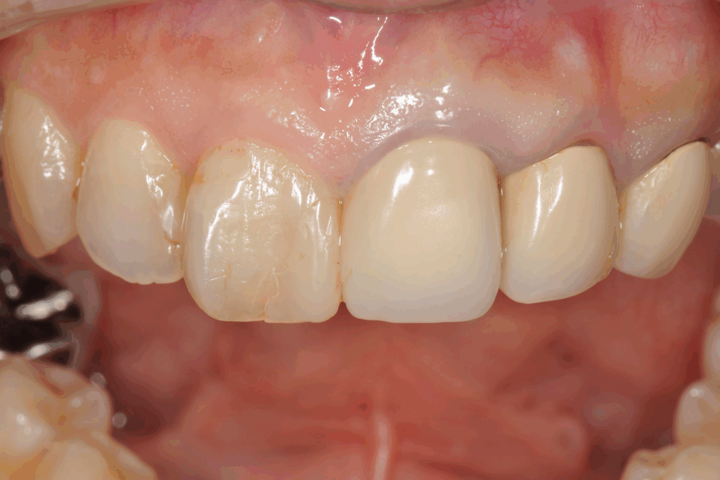 前歯を綺麗にしたい（30代）セラミック修復