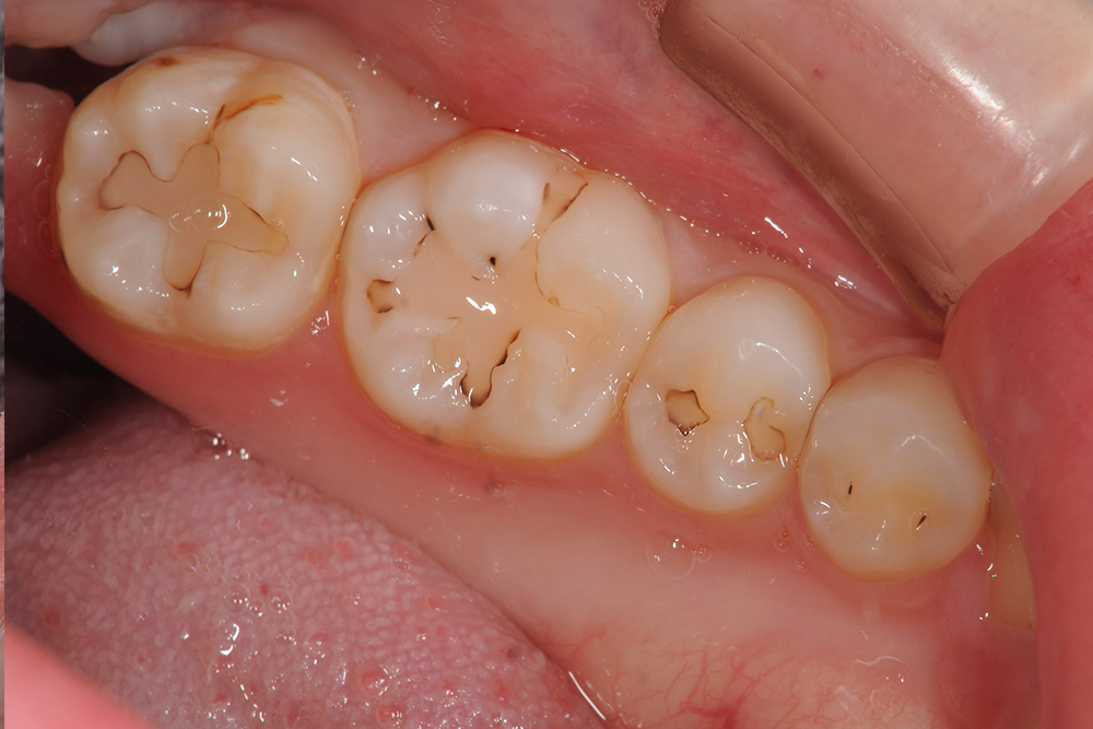 虫歯治療（20代）ダイレクトボンディング