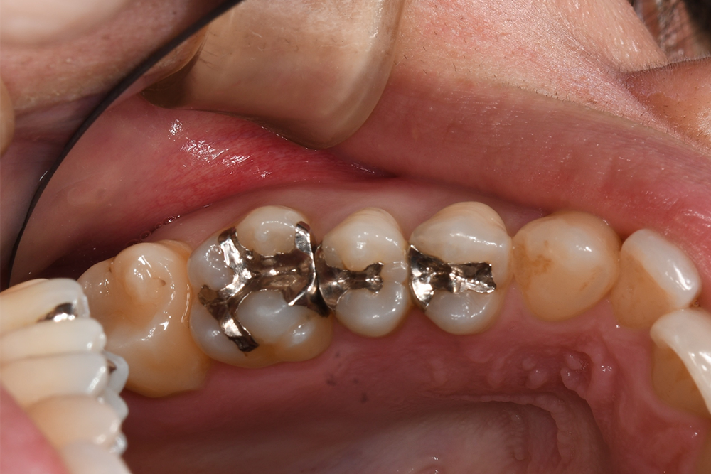 銀歯を白くしたい（40代）セラミックインレー
