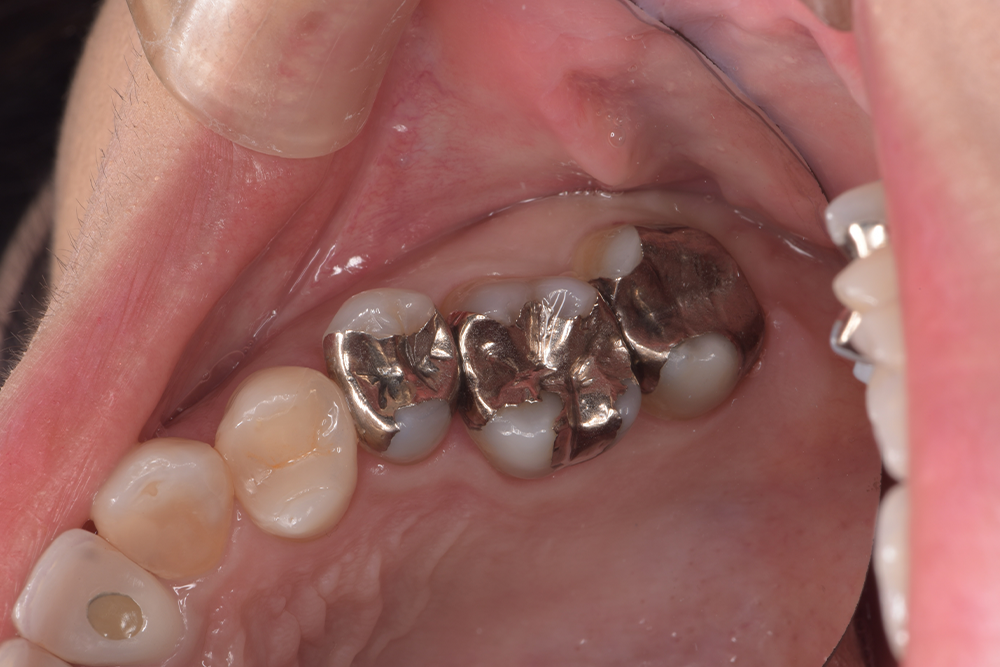 銀歯の隙間にフロスが引っかかる（50代）セラミックインレー