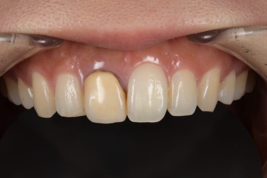 差し歯の色が違う（20代）セラミック修復