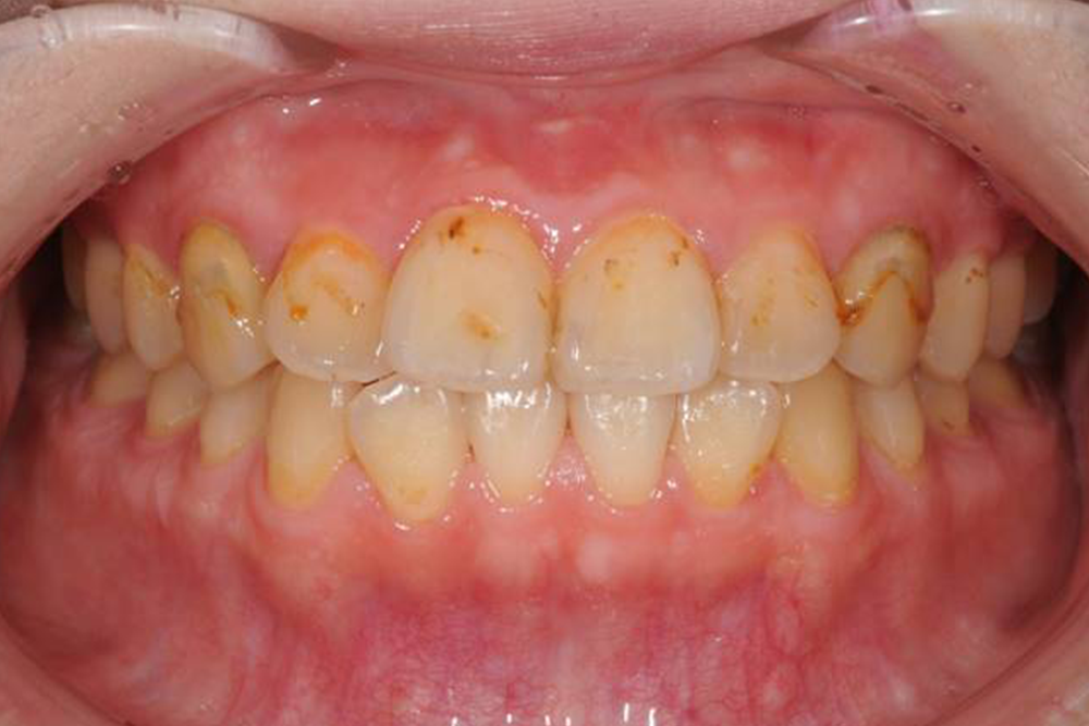 前歯を綺麗にしたい（20代）ホワイトニング ・ダイレクトボンディング