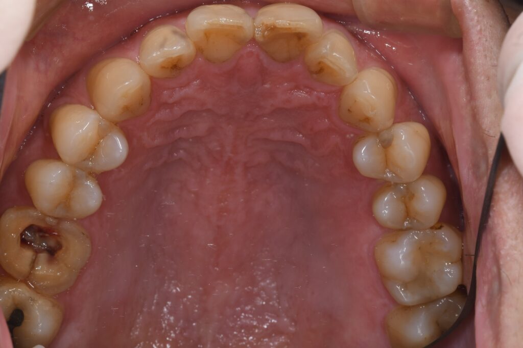 被せ物が取れている（50代）インプラント
