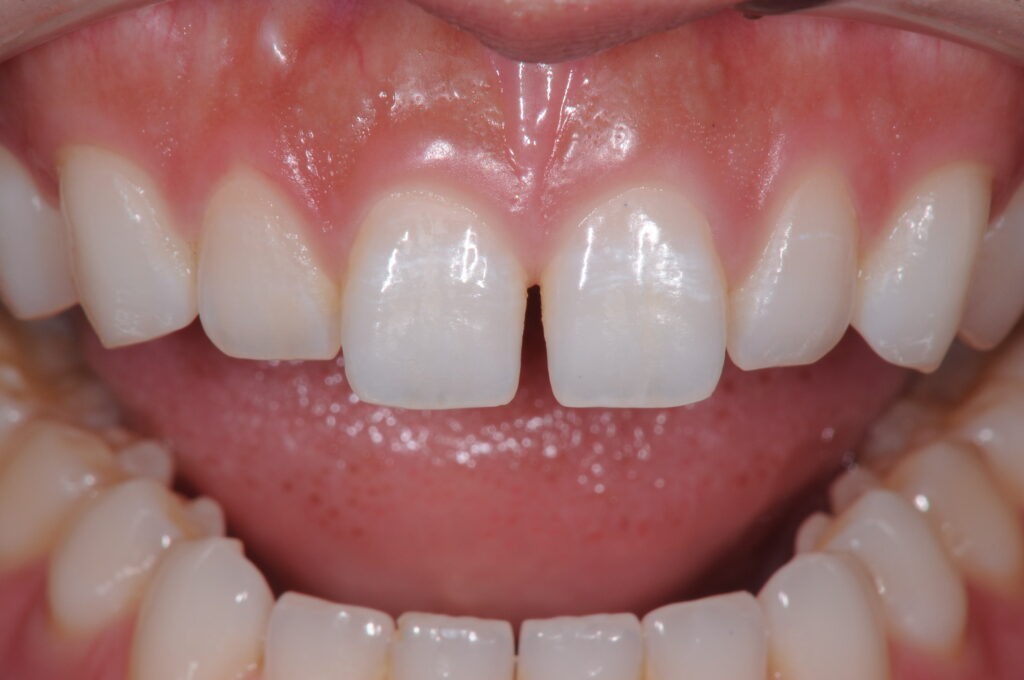 歯の隙間を埋めたい（30代）ダイレクトボンディング