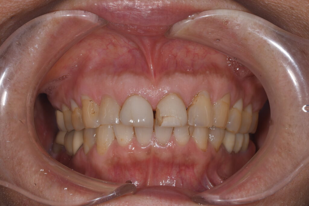 前歯が欠けた（60代）セラミック修復・ホワイトニング