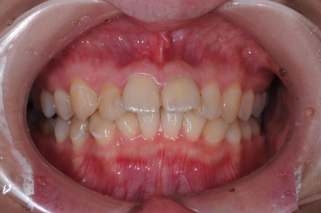 ガタガタの前歯を治したい（20代）セラミック修復・ダイレクトボンディング・ホワイトニング