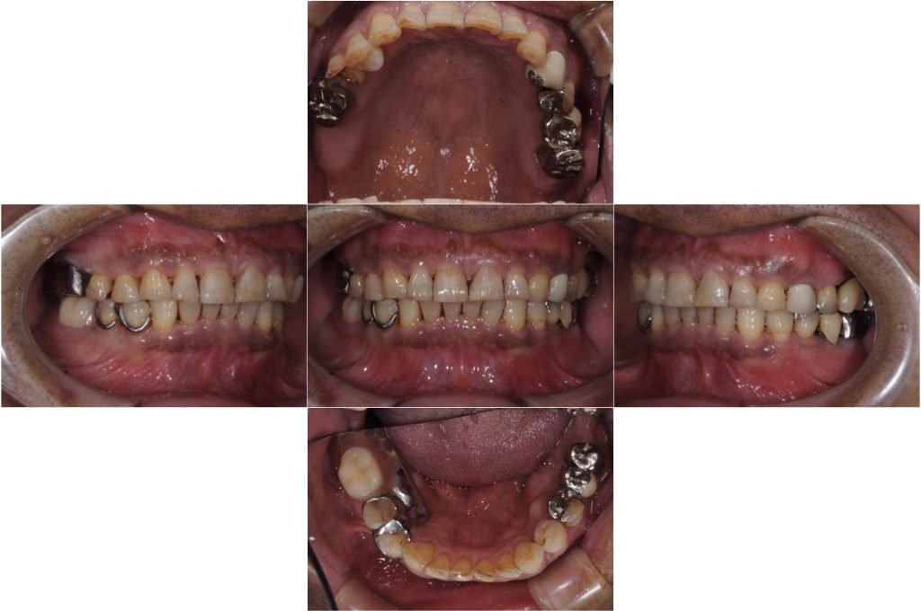 被せ物が外れた（60代）インプラント・セラミック修復