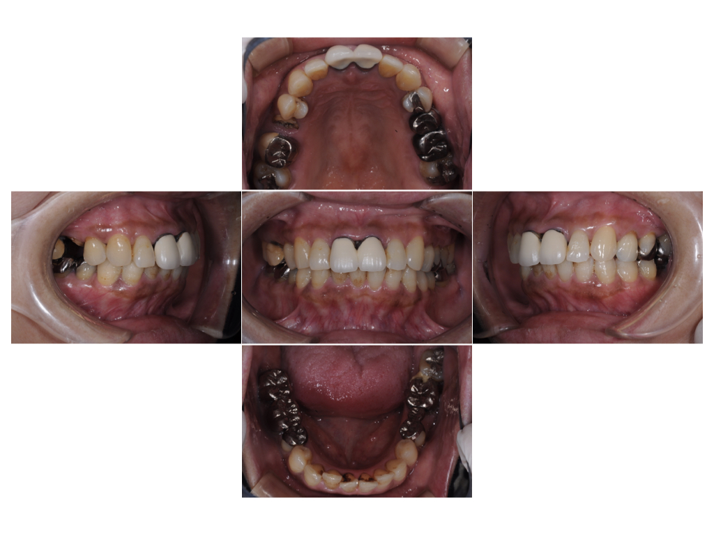 右上の歯が折れた1（50代）セラミック修復・ダイレクトボンディング