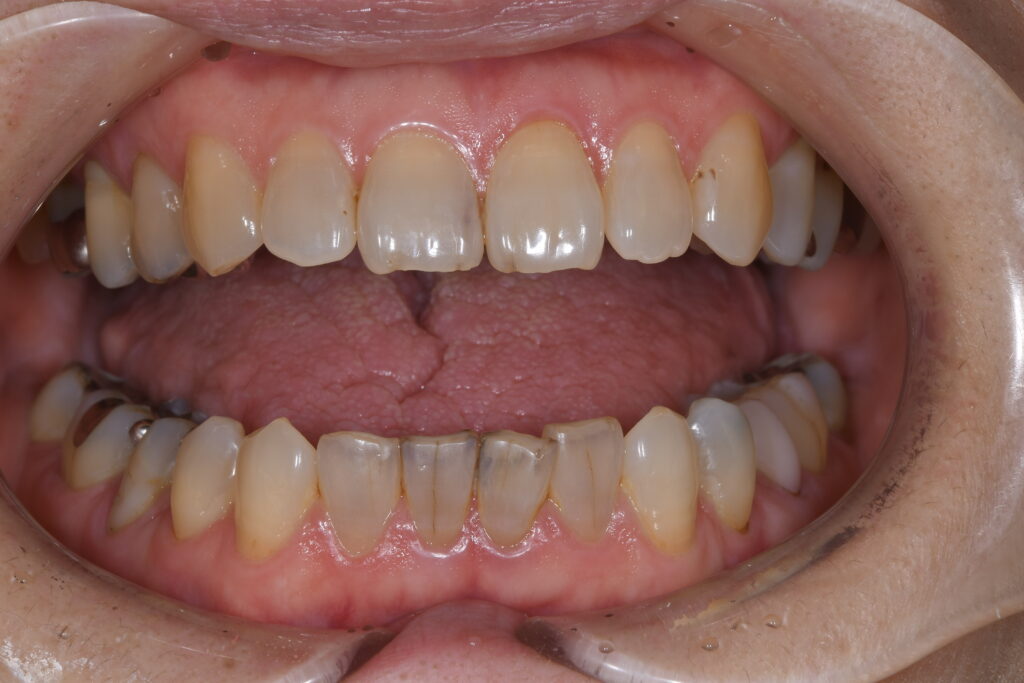 下の前歯を綺麗にしたい（60代）セラミック修復・ホワイトニング