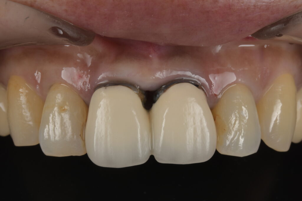 右上の歯が折れた2（50代）セラミック修復・ダイレクトボンディング