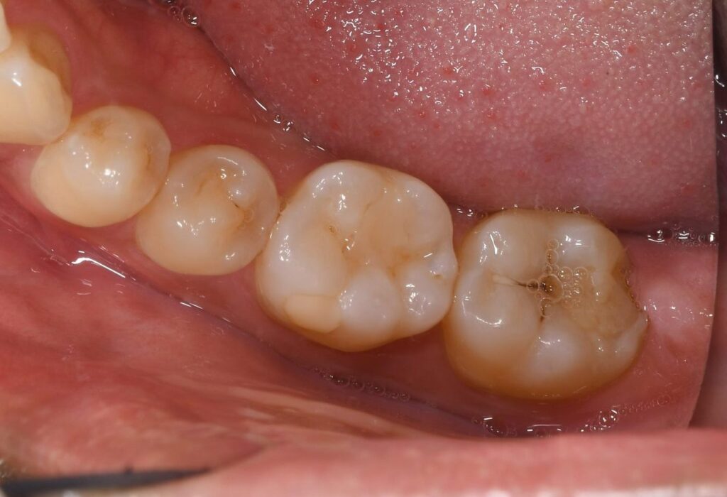 歯が欠けた（20代）セラミックインレー