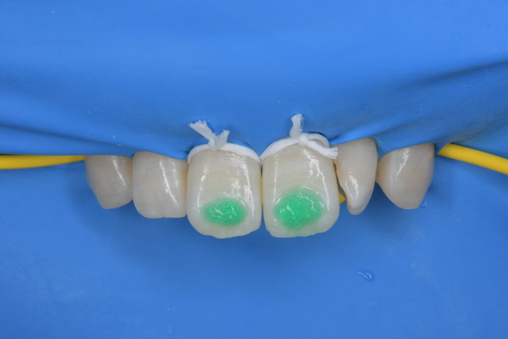 歯の白濁が気になる（30代）アイコン