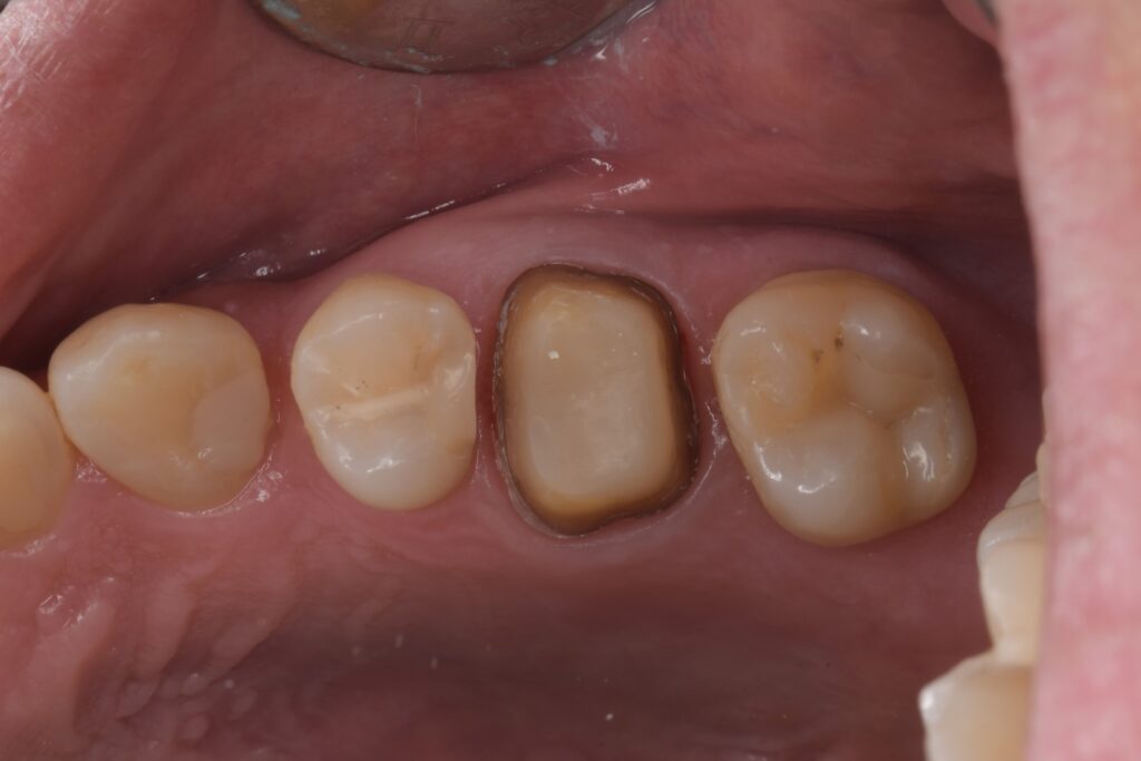 虫歯治療（40代）ダイレクトボンディング、セラミッククラウン