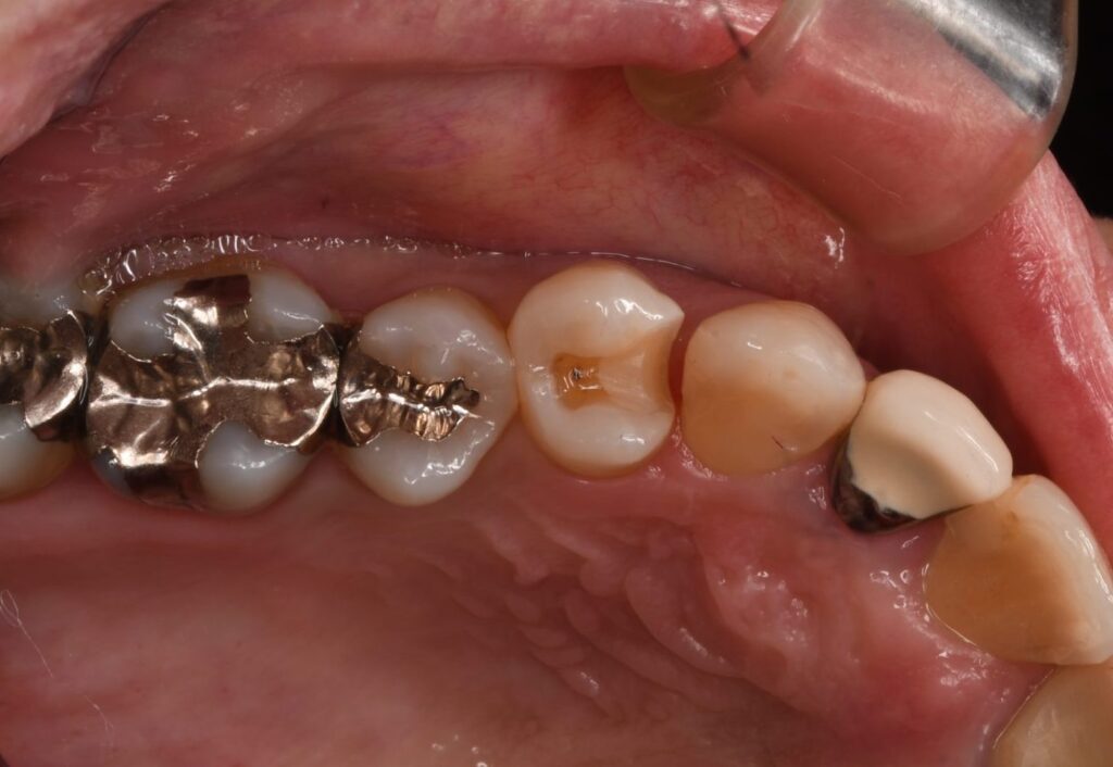 銀歯が外れた（40代）セラミックインレー