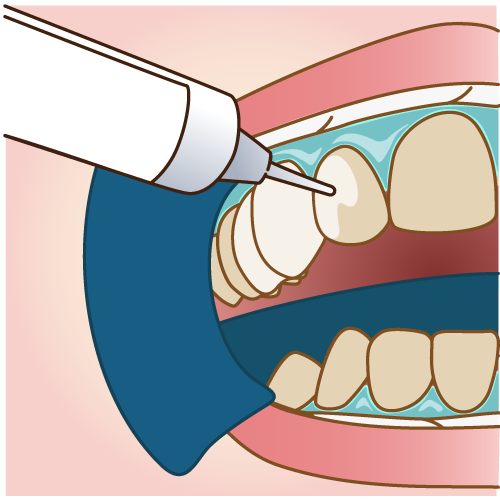 歯の表面に薬剤を塗布