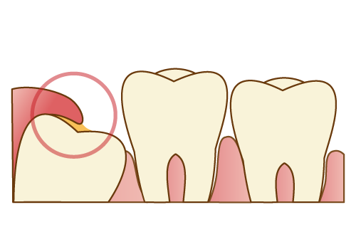 抜歯する親知らずのケース