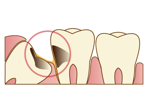 抜歯する親知らずのケース