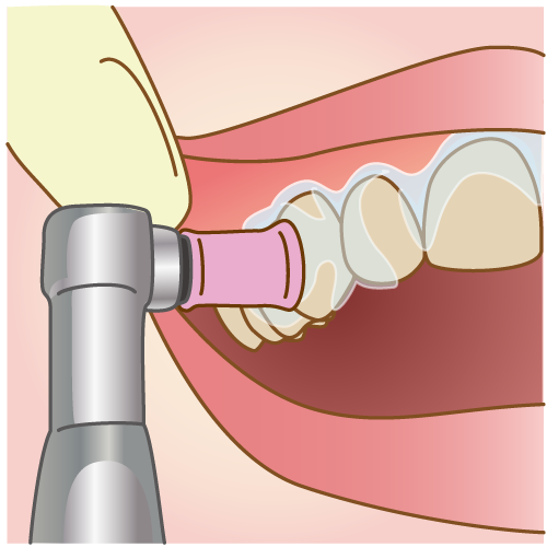 歯をしっかりクリーニング