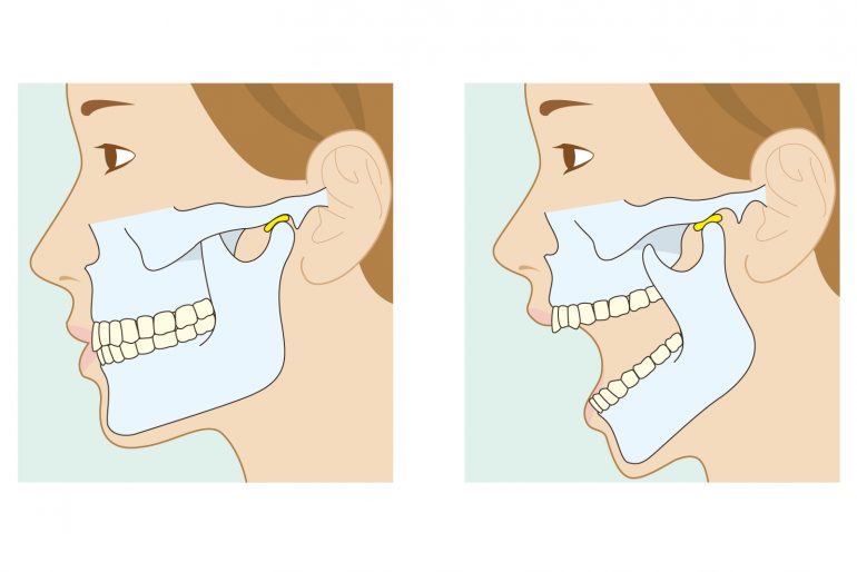 顎関節症