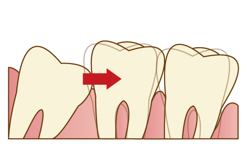 抜歯する親知らずのケース
