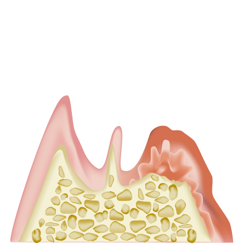 歯周炎(重度)