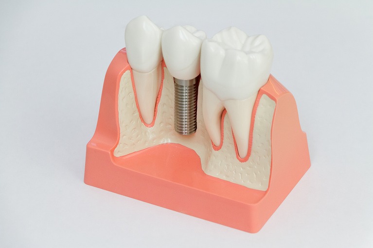 しっかり噛めて見た目も自然なインプラント