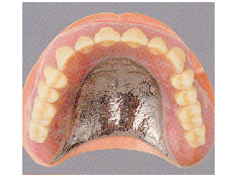 チタン床義歯