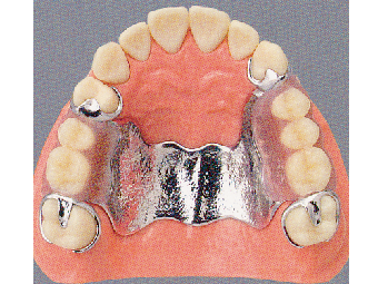 コバルト床義歯