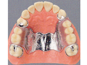 チタン床義歯