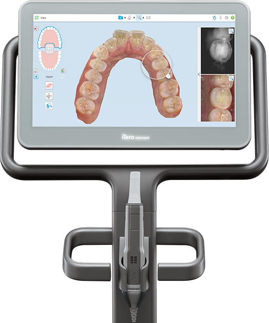 口腔内スキャナ―の「iTero（アイテロ）」